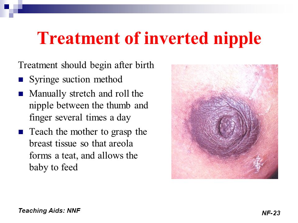 breast causes nipples inverted of